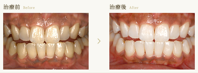 歯を削らずに白くするホワイトニング